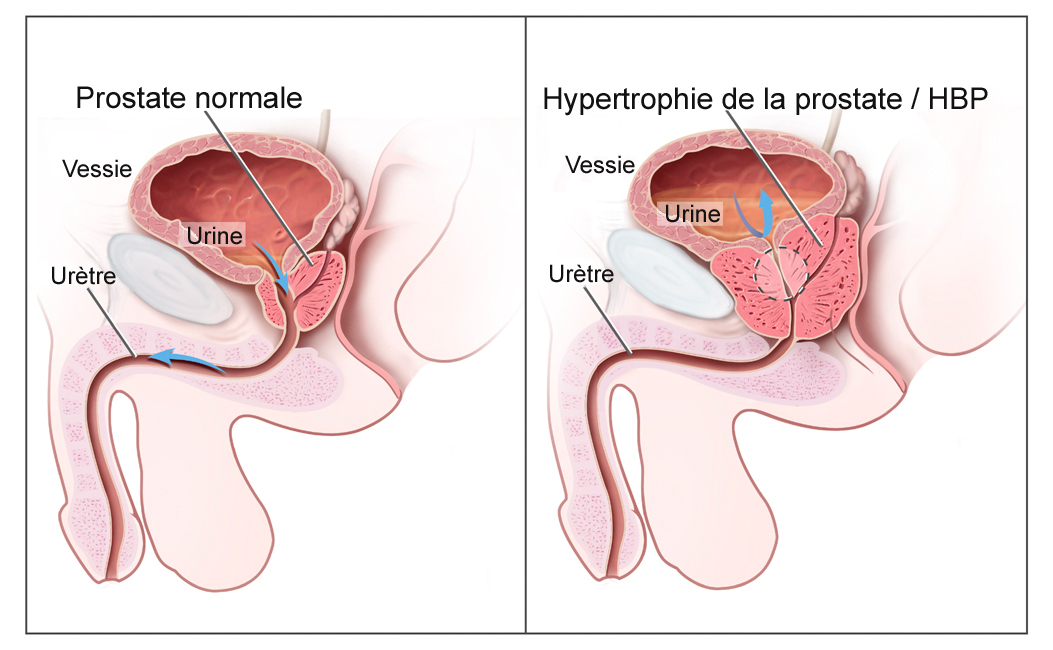 Hypertrophie_bénigne_de_la_prostate