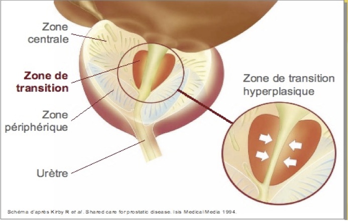 Prostate Zone de transition