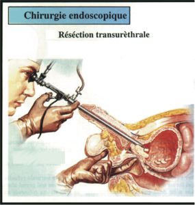 Schema Résection Transuretrale de la Prostate RTUP RTP Vincent Hupertan Urologue Paris